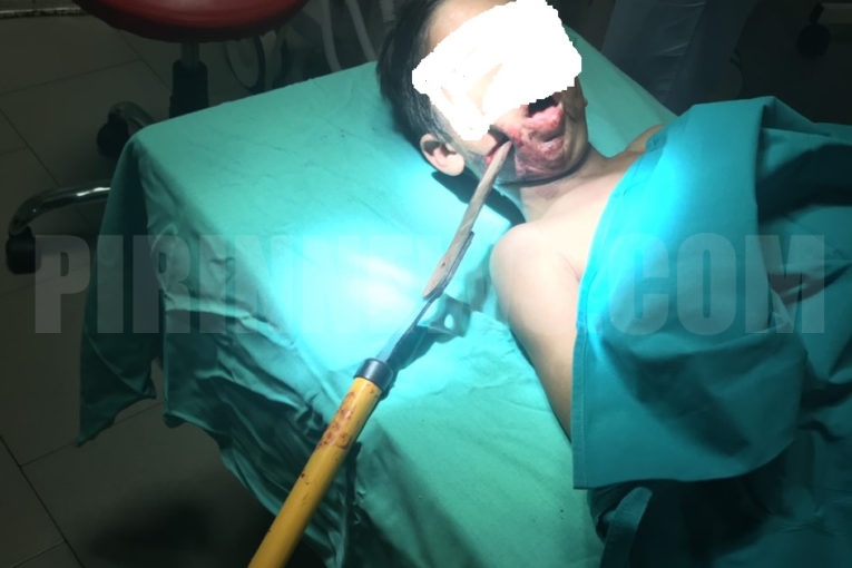 7-г. момче със забита в главата градинска ножица шокира лекарите-СНИМКИ